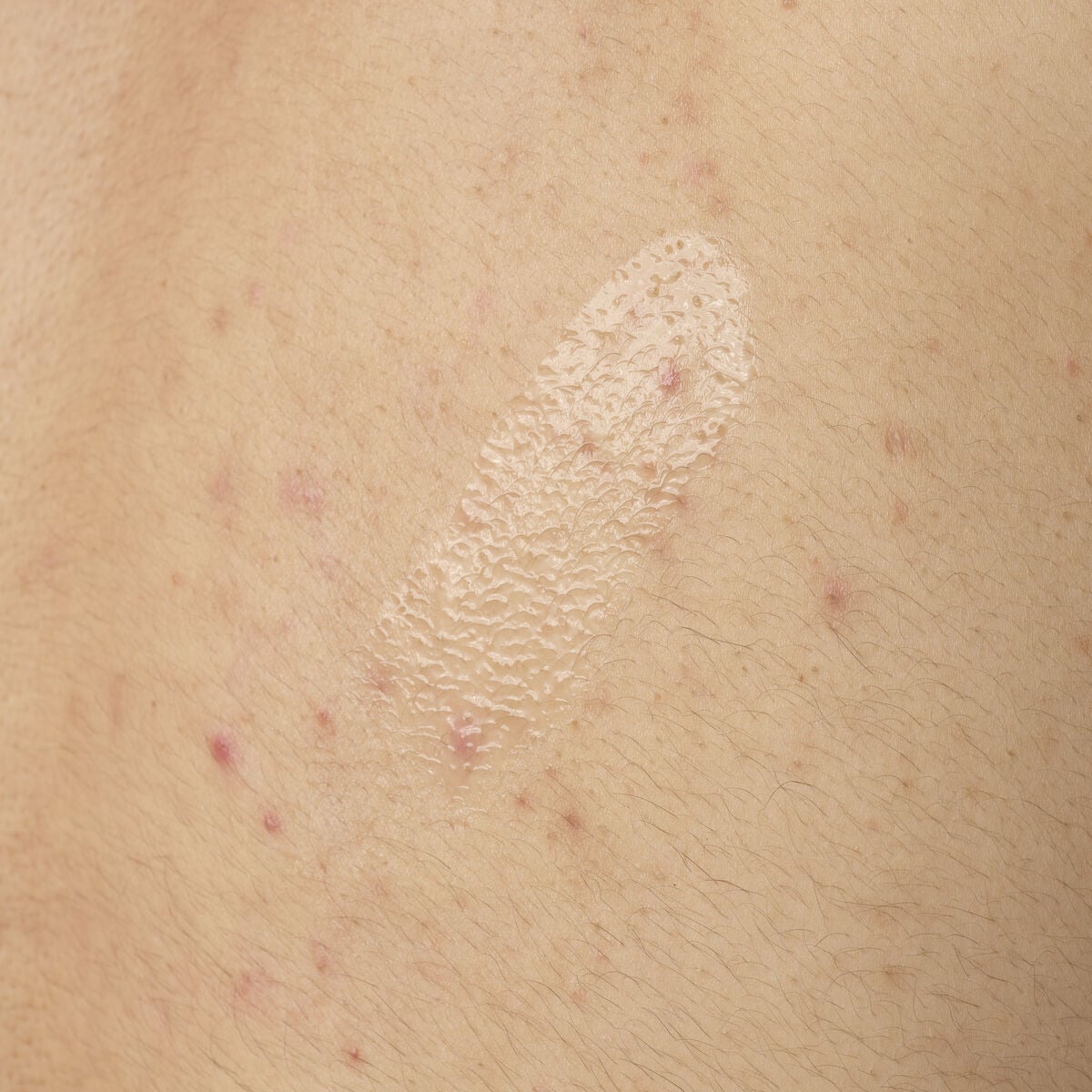 salicylic-acid-0-5-body-serum-f1 ORD-salicylic-acid-05-body-240ml-application.jpg