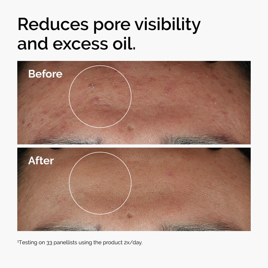niacinamide-10-zinc-1-p8 ord-niacinamide-zinc-blemish-serum-before-after-pores.jpg