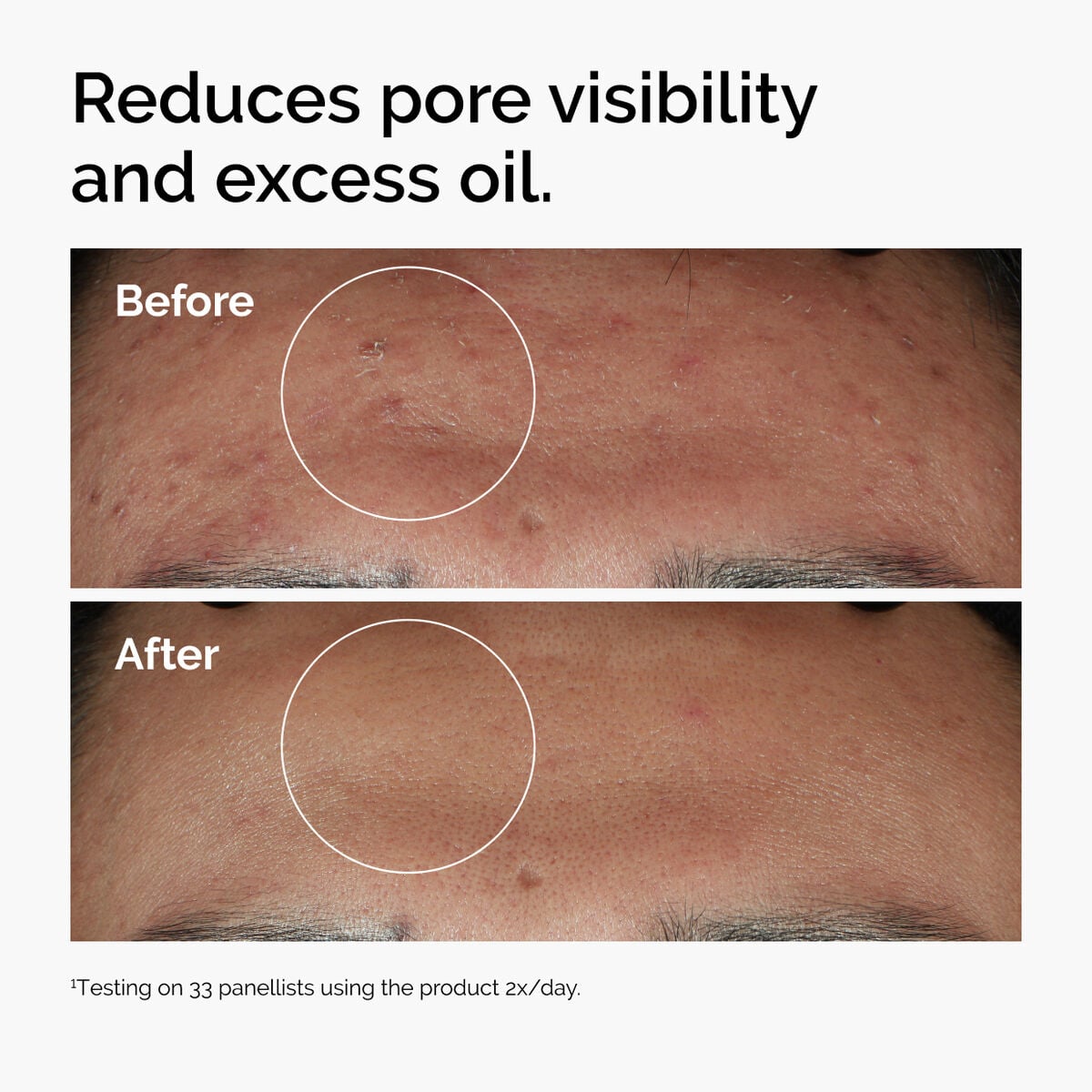 niacinamide-10-zinc-1-p8 ord-niacinamide-zinc-blemish-serum-before-after-pores.jpg