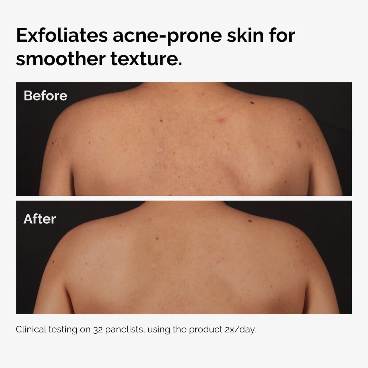 salicylic-acid-0-5-body-serum-f1 ord-salicylic-acid-body-serum-before-after-graphic-NA.jpg