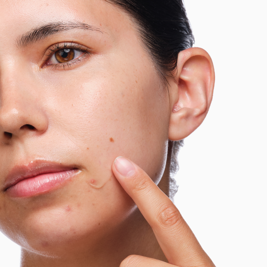 the-acne-set-t1 rdn-the-acne-set-application.png